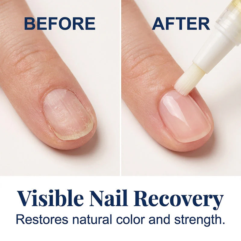 Nail Recovery — Nagelpflege-Stift-Set | 1+1 GRATIS - Image 9